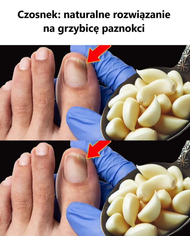 Czosnek: naturalne rozwiązanie na grzybicę paznokci